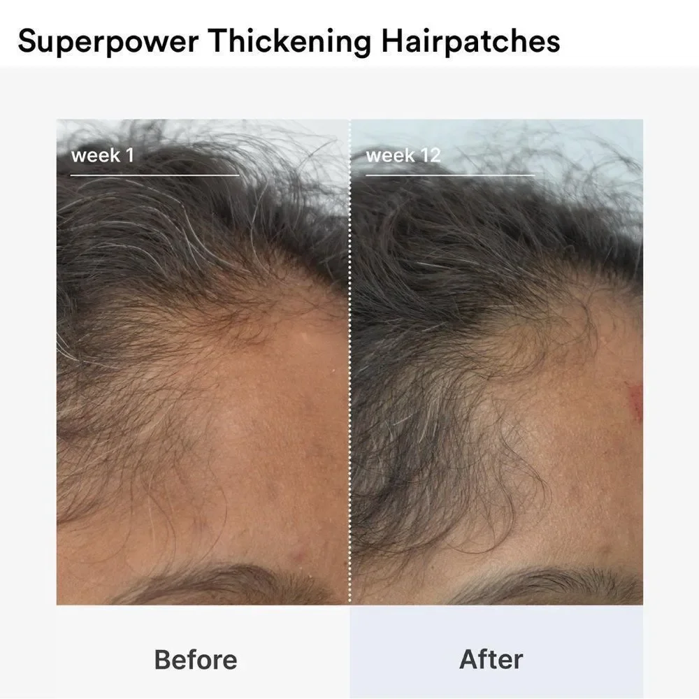 Superpower Thickening Hairpatches - Gold